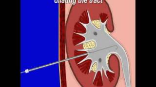 Percuteous Nephrostomy [upl. by Ettevi]