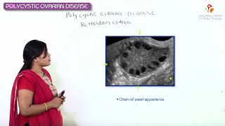 Polycystic ovary syndrome PCOS Part1  OBG  GYNE for Fmge and Neet pg by Dr Ramya sree [upl. by Ailey789]