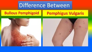 Difference Between Bullous Pemphigoid and Pemphigus Vulgaris [upl. by Assilac239]