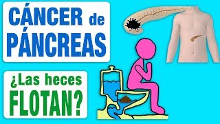 El cáncer de páncreas ¿hace flotar las heces [upl. by Ahsyekat]