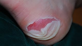 Blister Treatments 5 Natural Ways to Treat Foot Blisters  By Top 5 [upl. by Oskar]