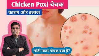 Chicken Pox Disease  Cause Symptoms and Treatment  Vaccine  चेचक का इलाज [upl. by Anitsirhk]