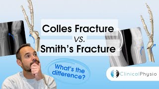 Colles Vs Smiths Fractures  Expert Physio Guide [upl. by Schubert]