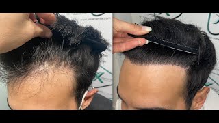 Trasplante Capilar  Hair Transplant  Dra Ximena Vila 1301 Grafts [upl. by Ornas]