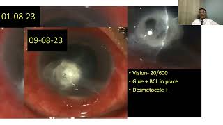 Lecture Microbial Keratitis in the Developing World [upl. by Sacken]