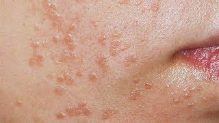 How to Get Rid of Flat Warts Fast  Easy Remove Warts [upl. by Lsiel200]