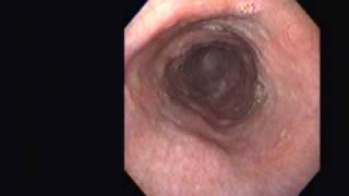 Achalasia Vs Pseudoachalasia [upl. by Icyac949]