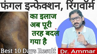 Fungal infection ka treatment ab puri tarah badal gaya hai Best treatment for fungal amp Ringworm [upl. by Zedekiah]