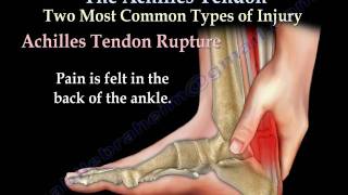 Achilles Tendon rupture tear tendonitis  Everything You Need To Know  Dr Nabil Ebraheim [upl. by Bendicty272]