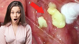 How to Remove Tonsil Stones You Cant See with 8 Remedies [upl. by Ahsenwahs]