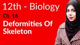 2nd Year Biology Ch 16  Deformities of Skeleton  12th Class Biology [upl. by Nylatsyrc]