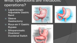 Metabolic Surgery [upl. by Ludwigg988]