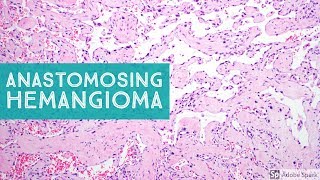 Anastomosing Hemangioma 101Explained by a Soft Tissue Pathologist [upl. by Eenttirb]