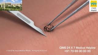 Skin Biopsy Hindi  CIMS Hospital [upl. by Metts]