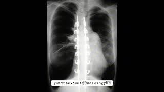 case 138 A1antitrypsin [upl. by Loferski]