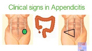 AppendicitisClinical examinations Medical signsMBS [upl. by Hazrit]