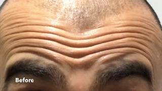 Brotox Forehead Lines Before and After  Mens Botox Results [upl. by Lanita]