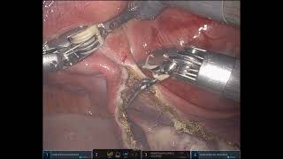 Minimally invasive davinci Robotic TLH with Ovarian suspension [upl. by Etnaled]