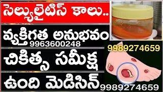 Cellulitis  Causes Symptoms Treatment amp Prevention In Telugu  part 2 [upl. by Quillan]