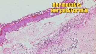 Dermatitis Herpetiformis [upl. by Sanson455]