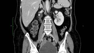 pyelitis CT [upl. by Jonette]