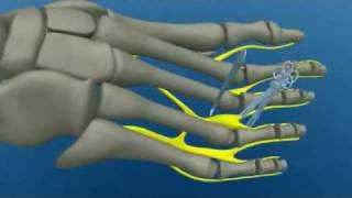 Surgery Mortons Neuroma Pain in Foot [upl. by Ahsitahs]