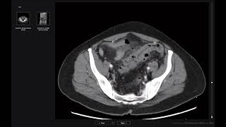 Introduction to abdominal CT [upl. by Anos]