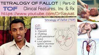 Tetralogy of Fallot TOF  Part 2  Clinical features Investigations amp Treatment  Dr Saykat [upl. by Yellek291]