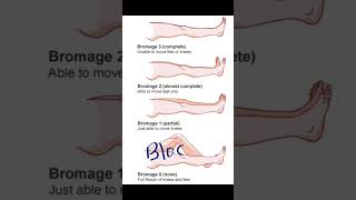 Bromage Score  Anesthesia painmanagement shoreyoutube viral video medical [upl. by Eelreveb]