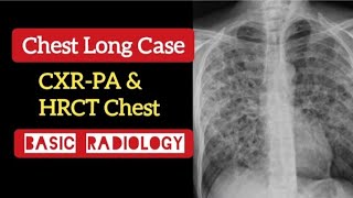 Pneumocystis jirovecii pneumonia  CXRPA amp HRCT HIV  Chest  Basic Radiology [upl. by Waechter]