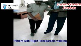 Gait Training with FES System Functional Electrical Stimulation for hemiplegic gait  stroke [upl. by Tuckie]