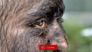 Hypertrichosis What is Werewolf Disease [upl. by Godred]