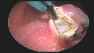 ENT Tonsillectomy with QMR Vesalius Device [upl. by Oneill]