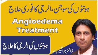 Honton ki allergy ka ilaj  How to Get Rid of Swollen Lips  Angioedema Treatment in Urdu [upl. by Uno]