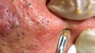 How To Remove Blackheads And Whiteheads On Face Easy 121 ✦ Dr Laelia ✦ [upl. by Leicester707]