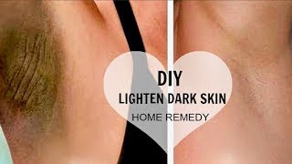 HOW TO LIGHTEN DARK UNDERARMS  SKIN NATURALLY amp FAST  amp DIY for Knees Elbows Thighs 100 WORKS [upl. by Trefler]