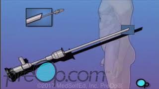 Male Cystoscopy Procedure  PreOp® Patient Education [upl. by Crescen540]