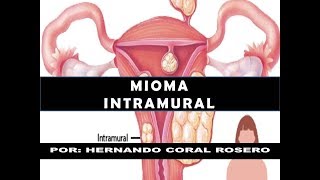 MIOMA INTRAMURAL [upl. by Geesey446]