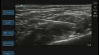 Ultrasound Guided Supraclavicular Nerve Block [upl. by Suixela706]