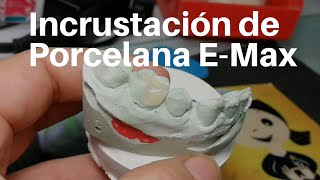 INCRUSTACIÓN Dental de Porcelana👅 EMax Onlay dentaltip [upl. by Devin877]