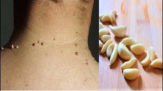 Remove Skin Tags  Home Remedies To Remove Skin Tags Easily [upl. by Zennie]