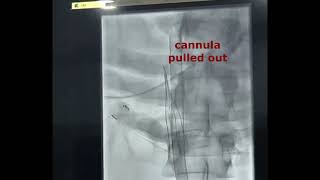 ECMO cannula explantation over IVC filter [upl. by Gare]