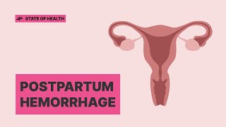 Postpartum hemorrhage Early detection can save lives [upl. by Angelica]