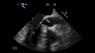 HOCM hypertrophische obstruktive Kardiomyopathie und SAM TEE [upl. by Nahej]