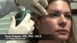 Juvederm Voluma Treatment of Temples in Fort Lauderdale [upl. by Okeim]