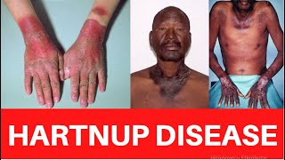 HARTNUP DISEASE Causes Treatment Symptoms Signs Diagnosis USMLEMnemonic Aminoaciduria [upl. by Eiggam]