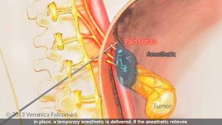 Celiac Plexus Block for Pancreatic Cancer Pain [upl. by Fulks]