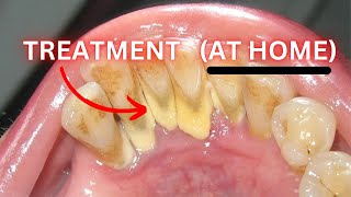 Gingivitis HOME Treatment Did Your Dentist Lie To You [upl. by Jordana257]