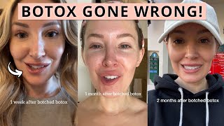 I Got Botched Botox  Before and After Bad Botox [upl. by Ahsya]