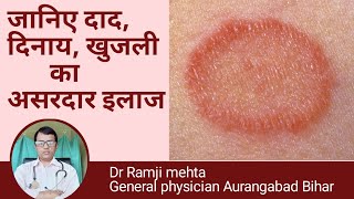 फंगस इंफेक्शन दाददिनाय का ईलाज Fungus Infection Treatment in Hindi Dr Ramji mehta [upl. by Adlei]